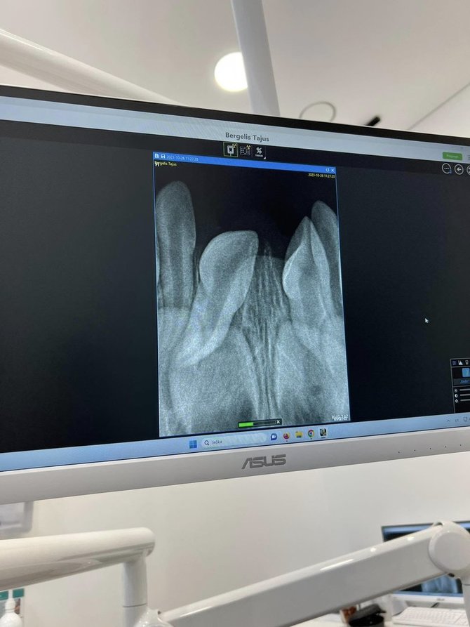 Asmeninė nuotr./Įsitikinti, kas nutiko su dantukais, pavyko tik įvertinus odontologines rentgeno nuotraukas