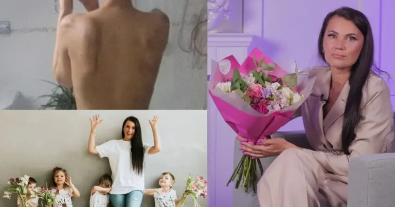 Nuo vyro kumščių pabėgusi ketvertuko mama Viktorija parodė mėlynėmis nusėtą kūną – vaizdas šokiruoja