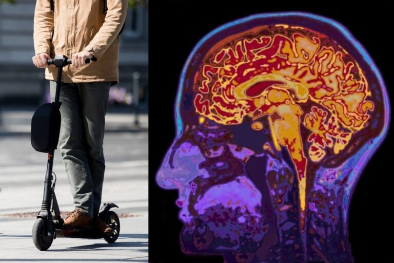 Gydytojai sunerimę dėl paspirtukų aukų antplūdžio: padariniai gali tęstis visą gyvenimą