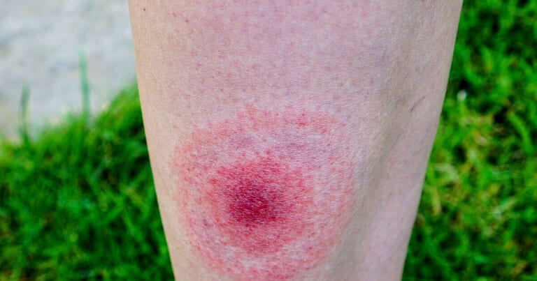 Laimo liga – pavojus, kurio nepastebite: ne visada pasirodo tipinis išbėrimas, pasekmės gali būti skaudžios