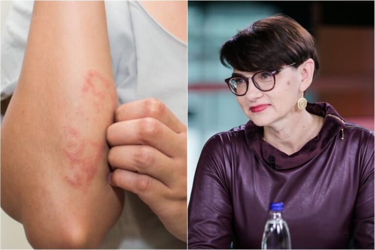 Alergijų banga: gydytoja įspėja — po 6 metų alergija gali paveikti kas antrą žmogų