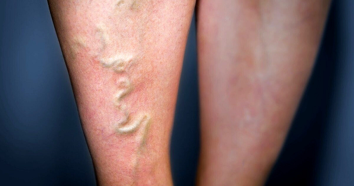 Venų išsiplėtimas: kaip suprasti, kada tai jau rimta problema?