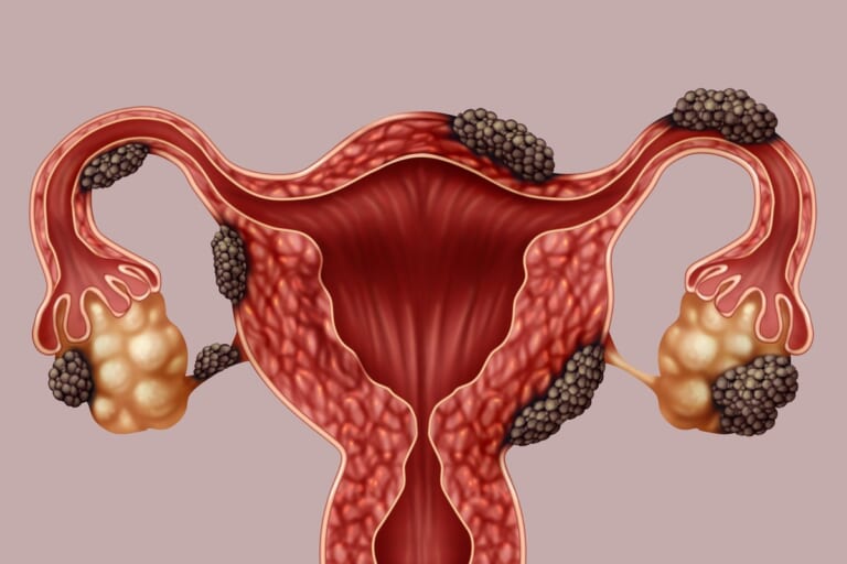 Endometriozė: daugelis to nežino — kada būtina kreiptis pagalbos?