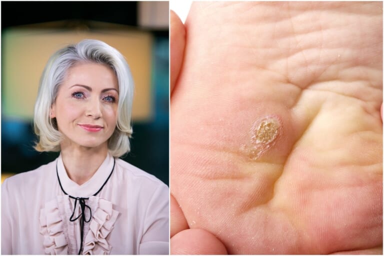 Dermatologė atskleidžia: kaip saugiai atsikratyti karpų – ko nedaryti, kad nepablogėtų