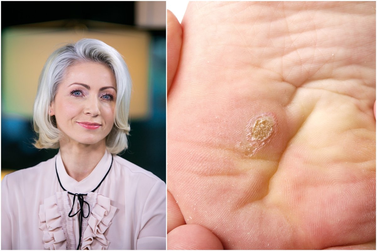 Dermatologė įspėja: kaip saugiai atsikratyti karpų ir ko jokiu būdu nedaryti