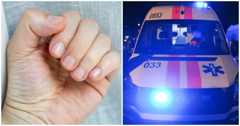 Pažvelkite į savo nagus: štai kokias sveikatos problemas jie gali išduoti