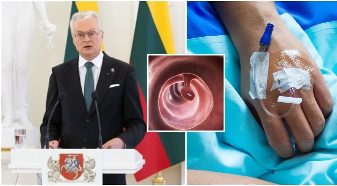 Šis darinys buvo aptiktas net prezidentui Gitanui Nausėdai: gydytoja įspėja – galite metų metus nieko nejausti, o pasekmės gali būti rimtos!